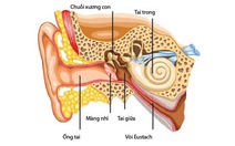 Coi chừng điếc vì viêm tai giữa