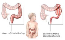 Trẻ sơ sinh bị táo bón có đáng lo?