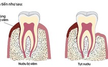 Tại sao cần phải cạo vôi răng?