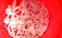 Sán xơ mít dài 9m trong bụng nam thanh niên