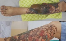 Xăm đầy cẳng chân rồi xóa bằng laser, một phụ nữ bỏng nặng