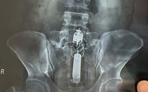 Nam bệnh nhân nhập viện cấp cứu vì kẹt đồ chơi tình dục trong trực tràng