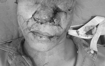 Sửa lại gương mặt bị giập nát sau tai nạn giao thông