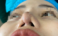 Nữ chủ spa bị biến dạng mũi sau 9 lần ‘sửa chữa’