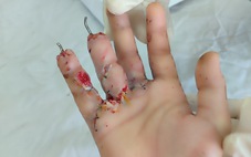 Bé trai bị giập nát bàn tay khi học làm pháo tự chế trên mạng