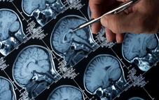 AI giúp phân loại khối u não chỉ trong vài giờ