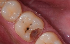 Vì sao bị sâu răng?