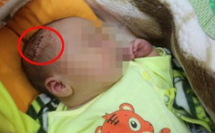 Vụ bé trai sinh mổ bị dao cắt rách da đầu, khâu 6 mũi: Bác sĩ thừa nhận sơ suất