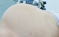 Cắt khối u buồng trứng lớn như có bầu 9 tháng cho nữ bệnh nhân