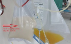 Bệnh nhân bị viêm tụy cấp có huyết tương trắng đục như sữa