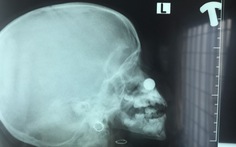 Nhét pin vào mũi, bé gái 4 tuổi bị axit phá hủy niêm mạc