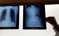 Trẻ nuốt phải tai nghe không dây, đi cấp cứu trong đêm