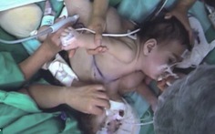 Chile: một trong hai bé song sinh dính liền đã qua đời