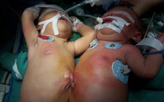 Kon Tum: Phẫu thuật tách cặp song sinh dính nhau
