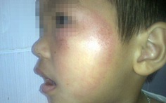 Trẻ mầm non bị mẹ hiệu trưởng dùng dép đánh vào mặt