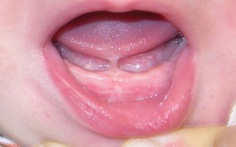 Blog bác sĩ: Nên cắt thắng lưỡi cho trẻ khi nào?