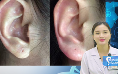 Tiêm tai tài lộc đầu năm, cần lưu ý điều gì?