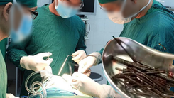 Video: Bác sĩ gắp 30 chiếc đinh sắt dài cả tấc từ bụng bệnh nhân 18 tuổi