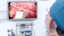 Video: Phẫu thuật cắt bỏ ruột thừa phát hiện tăm xỉa răng