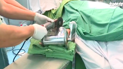 Video: Bác sĩ cắt máy xay thịt để lấy bàn tay dập nát của một phụ nữ