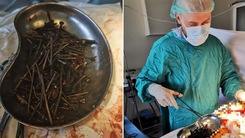 Video: Phẫu thuật lấy hơn 1kg đinh ốc trong dạ dày bệnh nhân