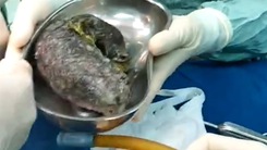 Video: Phẫu thuật lấy búi tóc nửa ký trong bụng bé gái 7 tuổi ở Quảng Ngãi
