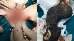 Video: Phẫu thuật lấy búi tóc nặng gần 1kg trong dạ dày nữ bệnh nhi 11 tuổi