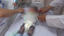 Video: Cứu sống bé trai bị thủy đậu hiếm gặp khi mới chào đời