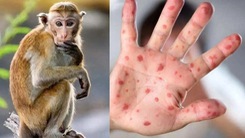Virus đậu mùa khỉ gây ra những triệu chứng gì, nhiễm bệnh có nguy hiểm đến tính mạng