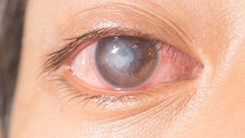 Mờ mắt sau khi đau mắt đỏ có phải là cảnh báo nguy hiểm?