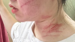 Video: Mẹ ruột đánh con gái 17 tuổi gây thương tích khắp người