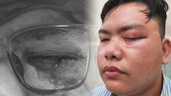 Vụ việc đang xác minh: bị gậy CSGT ‘tác động’, mảnh vỡ mắt kính găm vào mắt, phải mổ cấp cứu