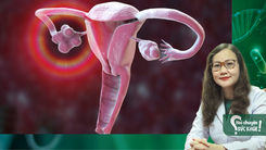 Hội chứng buồng trứng đa nang khiến vô sinh ở nữ có dấu hiệu ra sao?