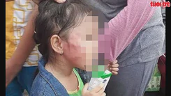 Tạm đình chỉ lớp mầm non nghi bạo hành trẻ em gãy xương hàm