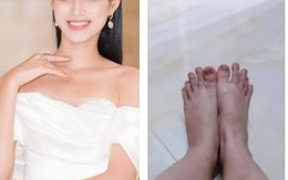 Hoa hậu Đỗ Thị Hà tự bóc điểm xấu trên cơ thể