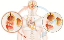 Đau đầu mãn tính thì nguy cơ cao bị đau lưng dai dẳng