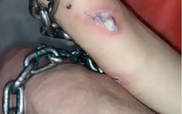 Cô gái bị lở loét cổ tay vì 'xích chung' với bạn trai