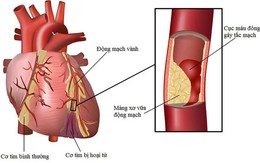 Bệnh động mạch vành, bạn có bao nhiêu phần trăm sẽ mắc phải?