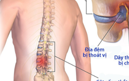 30% người Việt bị thoát vị đĩa đệm cột sống thắt lưng mà không biết