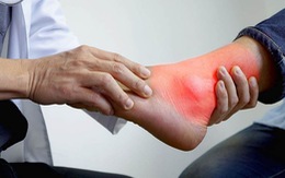 Bị gout cứ ăn chay là chân ái?