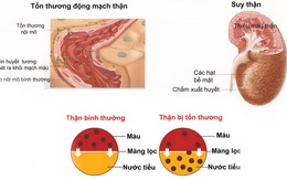 Những biến chứng nguy hiểm của bệnh sỏi thận, bạn có biết?