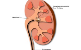 Lấy sỏi thận sao cho nhanh, ít di chứng?