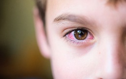 Chớ chủ quan với bệnh đau mắt đỏ