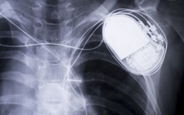 745.000 thiết bị máy điều hòa nhịp tim của Abbott có thể bị hack