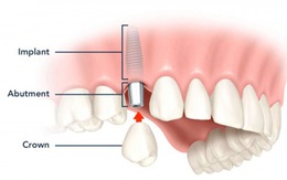 Kỹ thuật cấy ghép răng giả cùng lúc nhổ răng thật