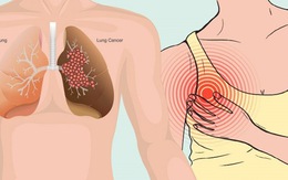 10 dấu hiệu cảnh báo sớm bệnh ung thư phổi