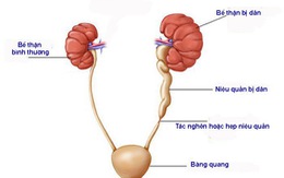 Những giải pháp tích cực khi bị thận ứ nước