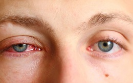 Bệnh đau mắt đỏ và các biện pháp phòng ngừa