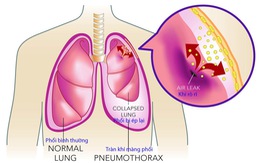 Tràn khí màng phổi tự phát