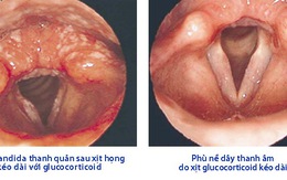 Tổn thương thanh quản do glucocorticoid xịt họng